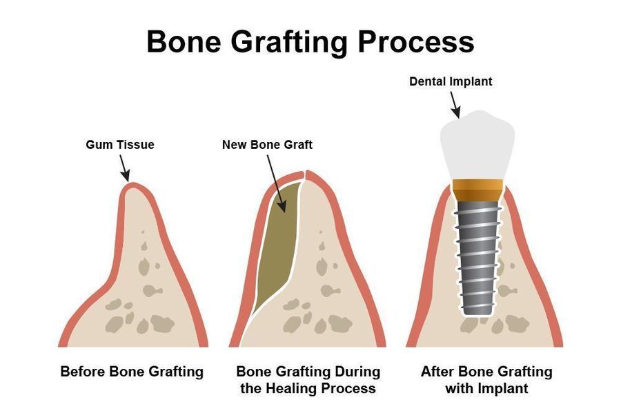 Bone grafting treatment illustration